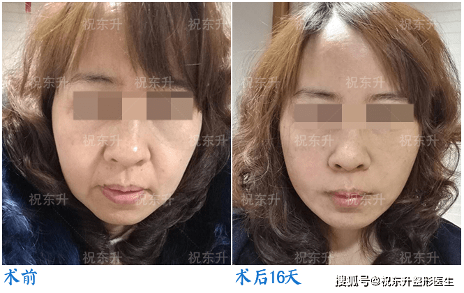 年轻女孩隆鼻手术悲剧，探讨事件背后的问题