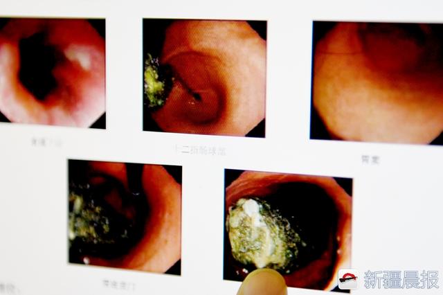 九岁女孩胃中取出四厘米头发团，医学奇迹的探索之旅